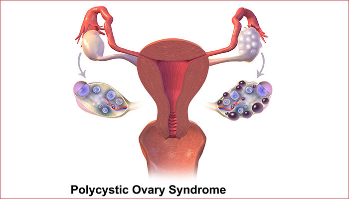 PCOS