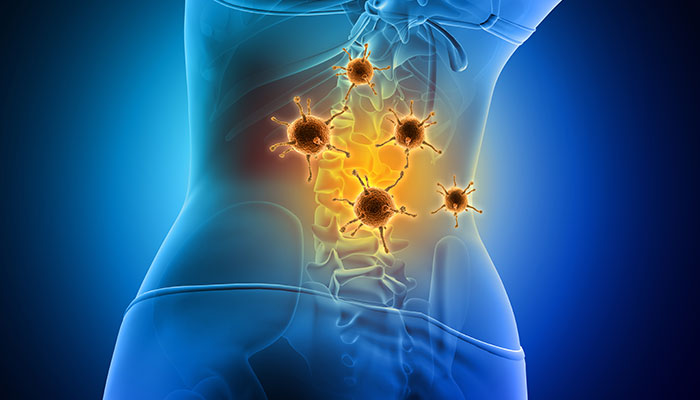 Causes of Lower Back Pain