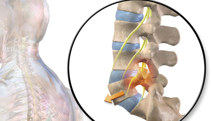 Causes of Lower Back Pain